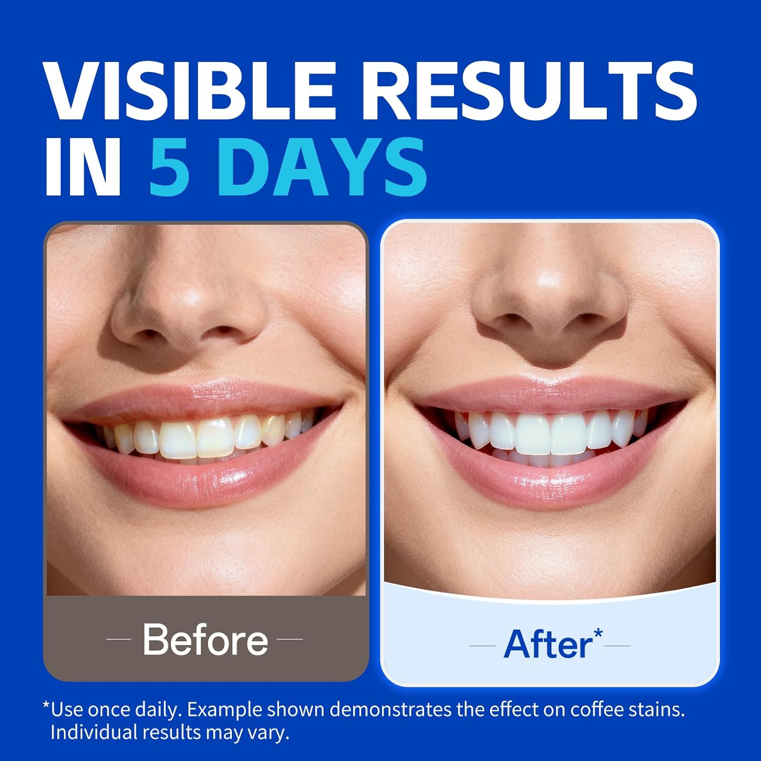7 pairs Teeth Whitening Strips - огляд і ціна Teeth Whitening Retainer