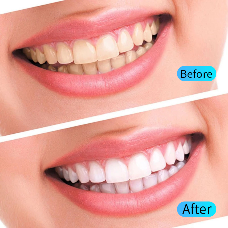 Teeth Whitening Gel Kit Oral H - огляд і ціна Teeth Whitening Filter
