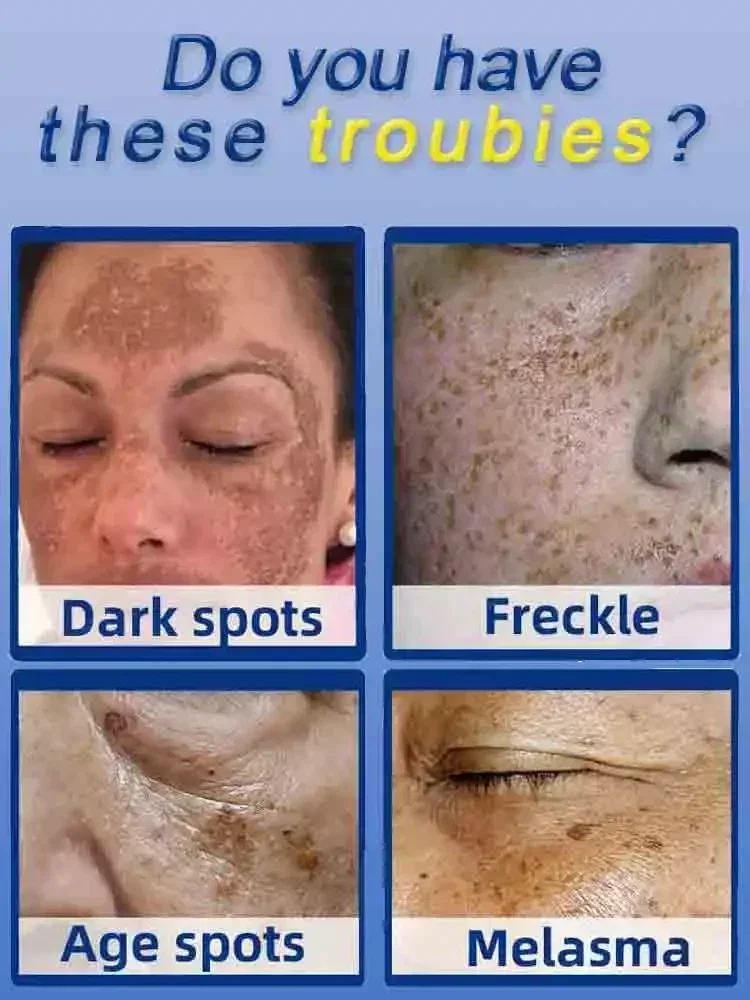 Dark Spot Remover for Face Rem - огляд і ціна Charcoal Whitening Paste