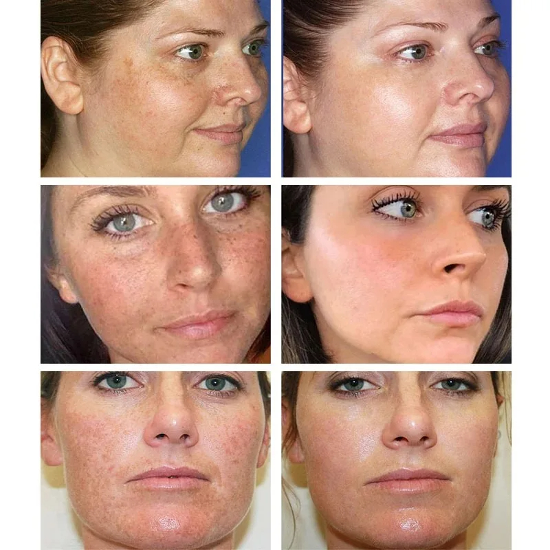 Whitening Freckle Cream Remove - огляд і ціна Charcoal Whitening Paste